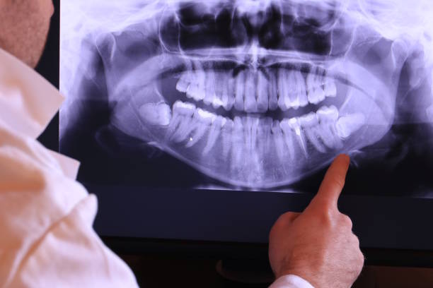 Best Emergency Wisdom Teeth Removal in Resaca, GA